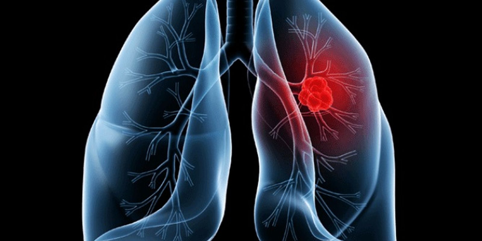 Cirurgia remove nódulo pulmonar de Papa Leão XIV